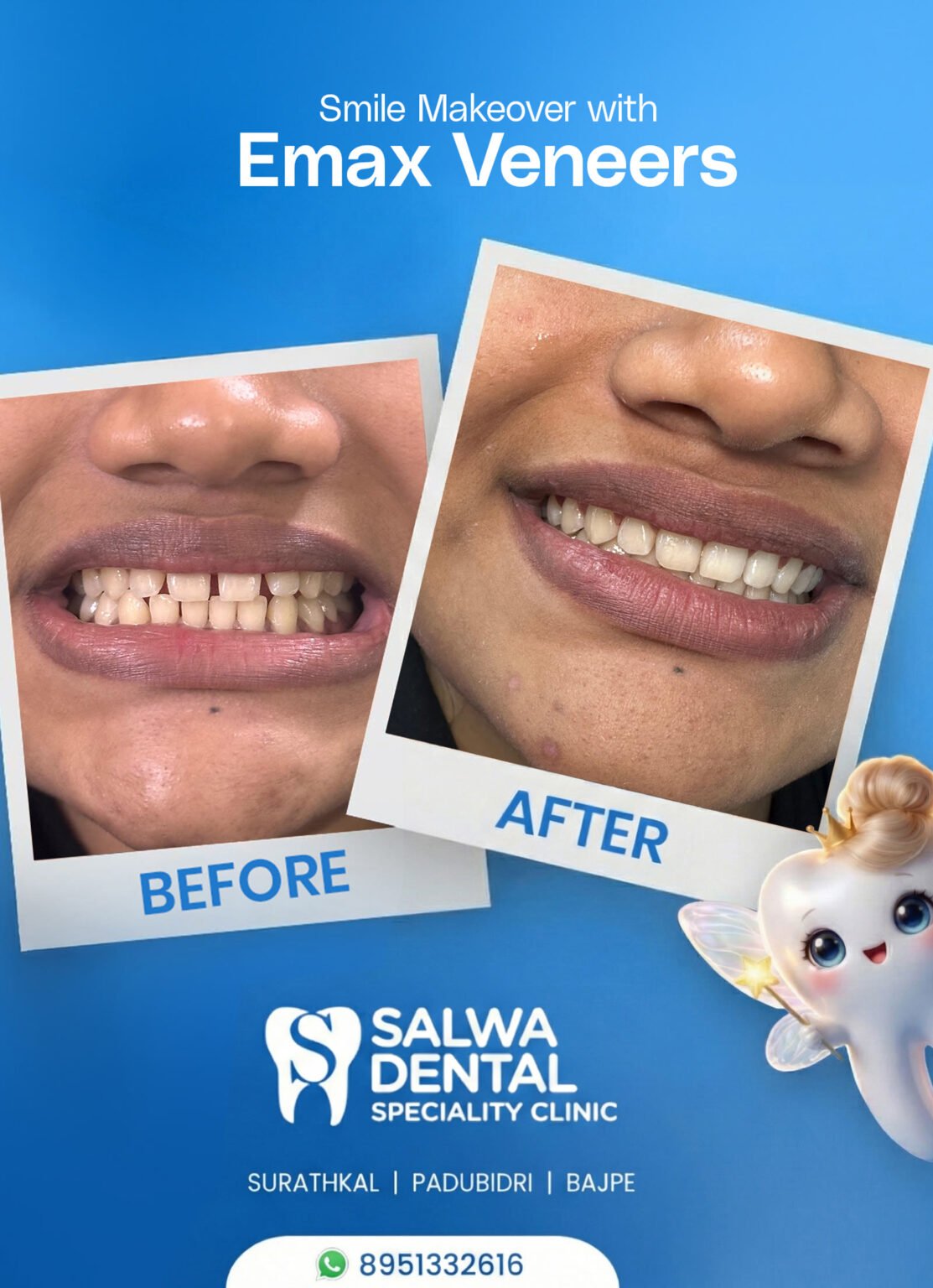 Salwa Dental Emax veneers before and after